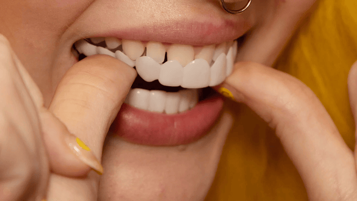 Omedelbar försköning av ditt leende med Snap-on-Veneers
