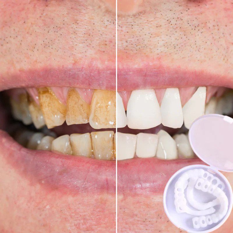 Snap-on Teeth™ – Med dessa skalfasader har du alltid ett perfekt leende.
